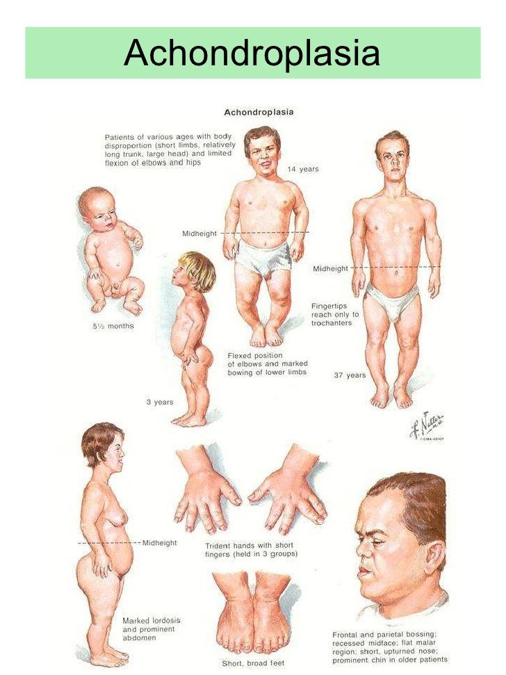 Achondroplasia