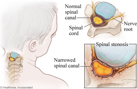 Cervical Stenosis