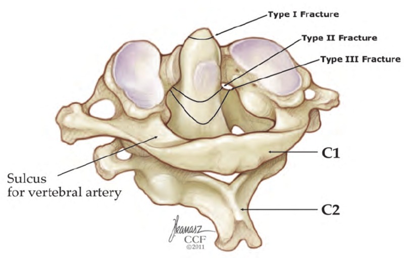 Different types of odontoid fractures