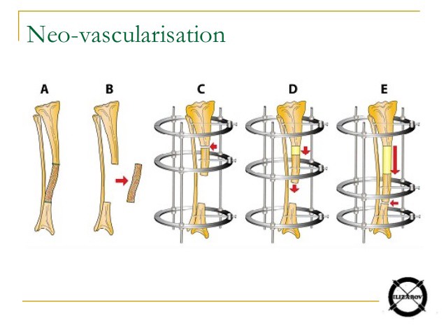 Limb straightening using Ilizarov apparatus