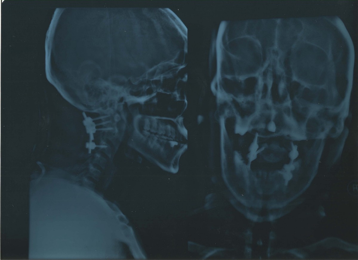 C1-C3 fusion X-ray taken couple of days after the surgery